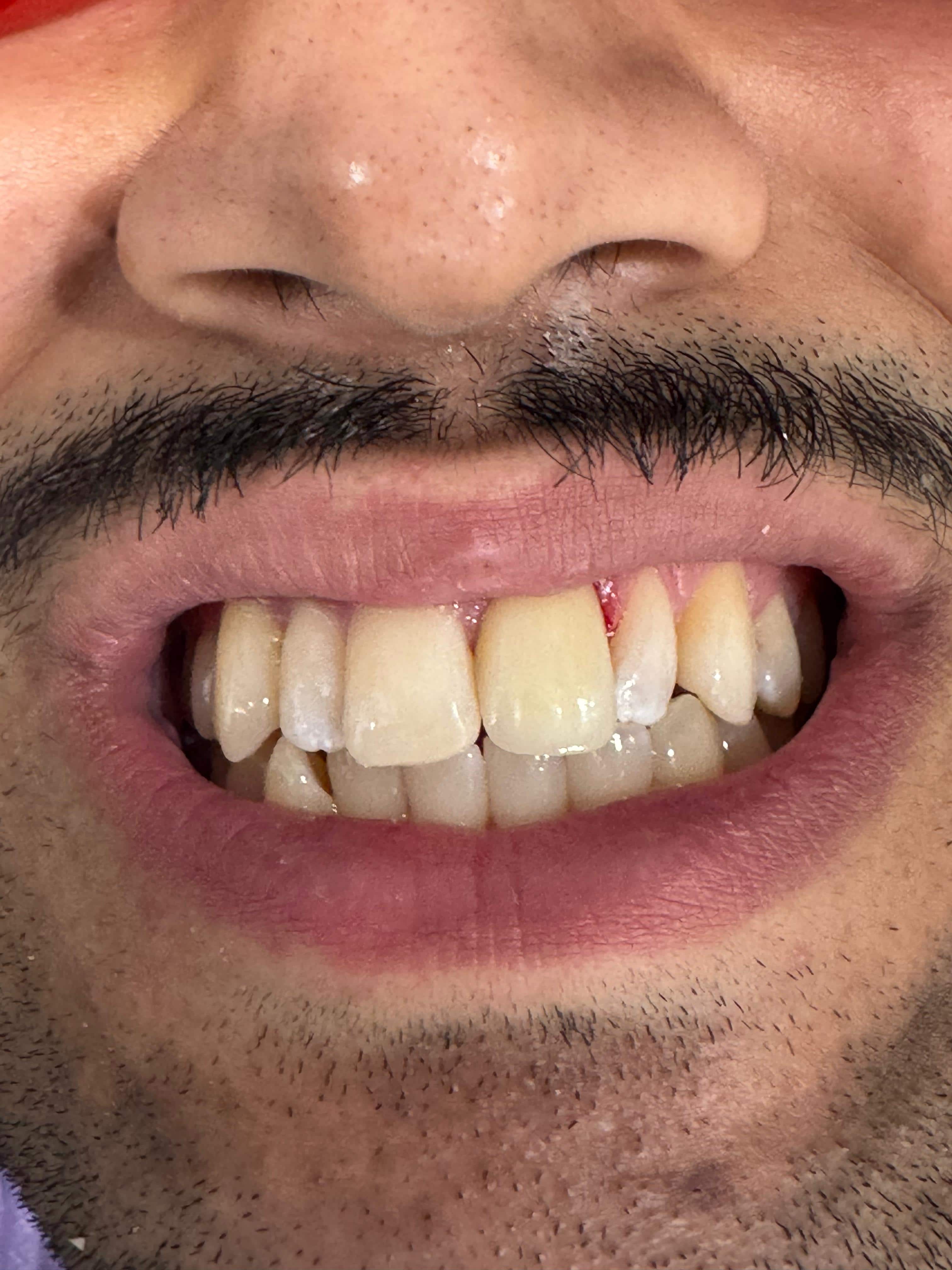 Dental Cap Crown: What Is the Difference?