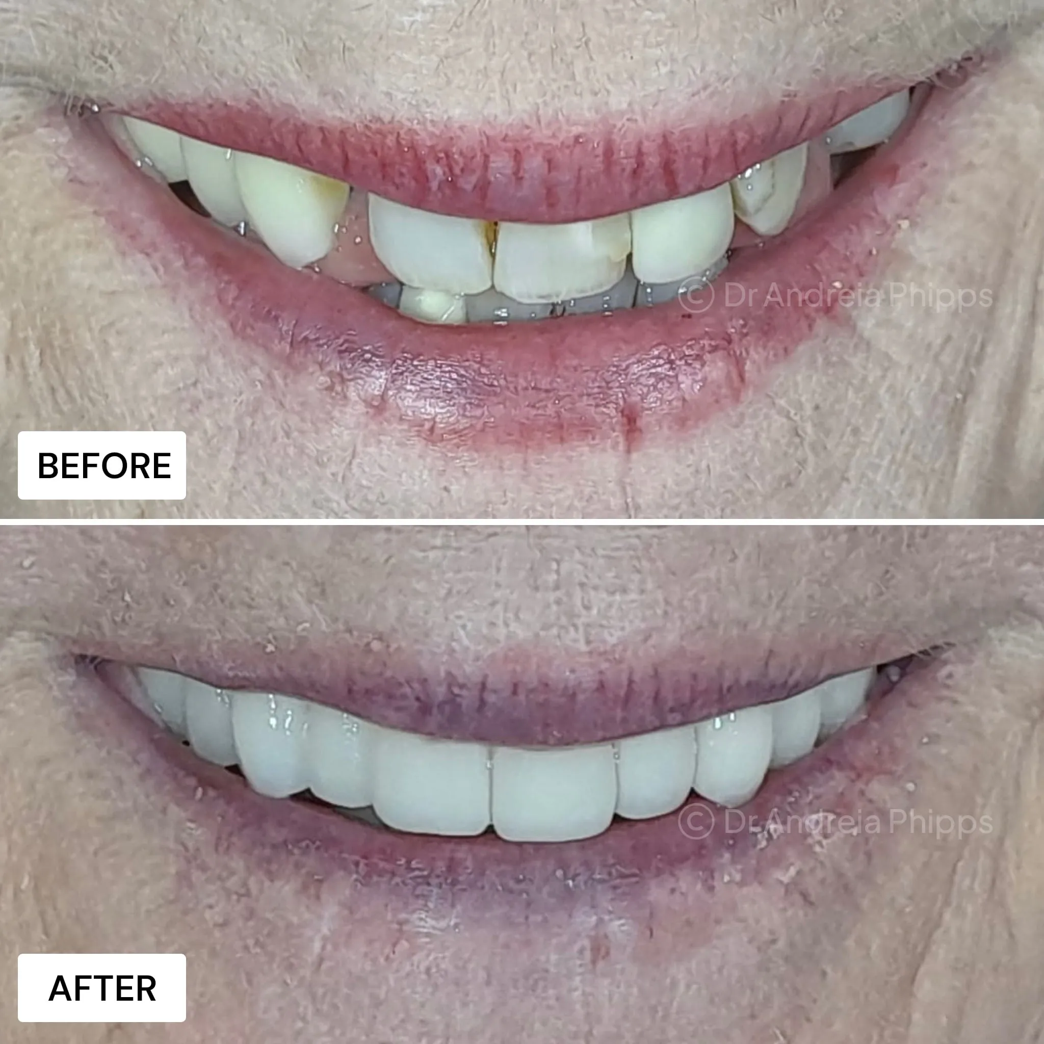 Smile transformation 13