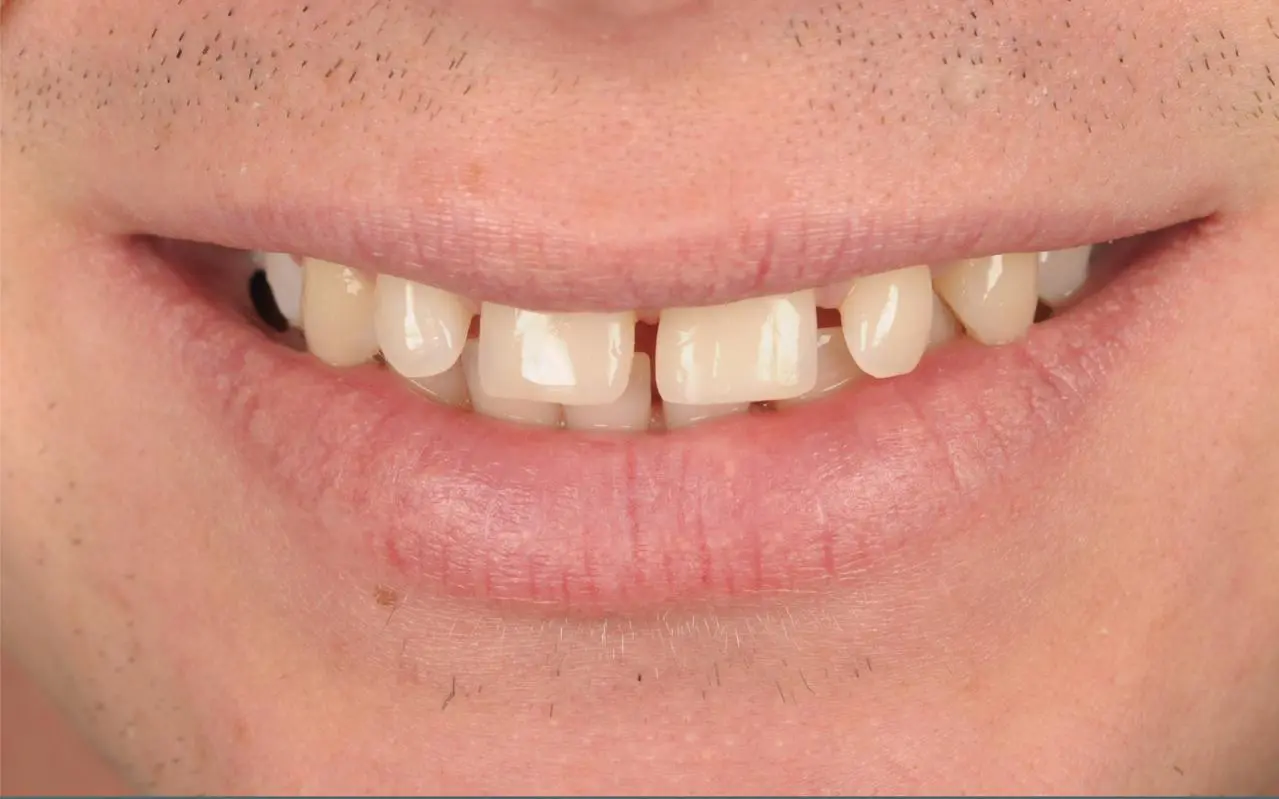 Gaps In Your Smile Causing Embarrassment? Lasting Restoration Care