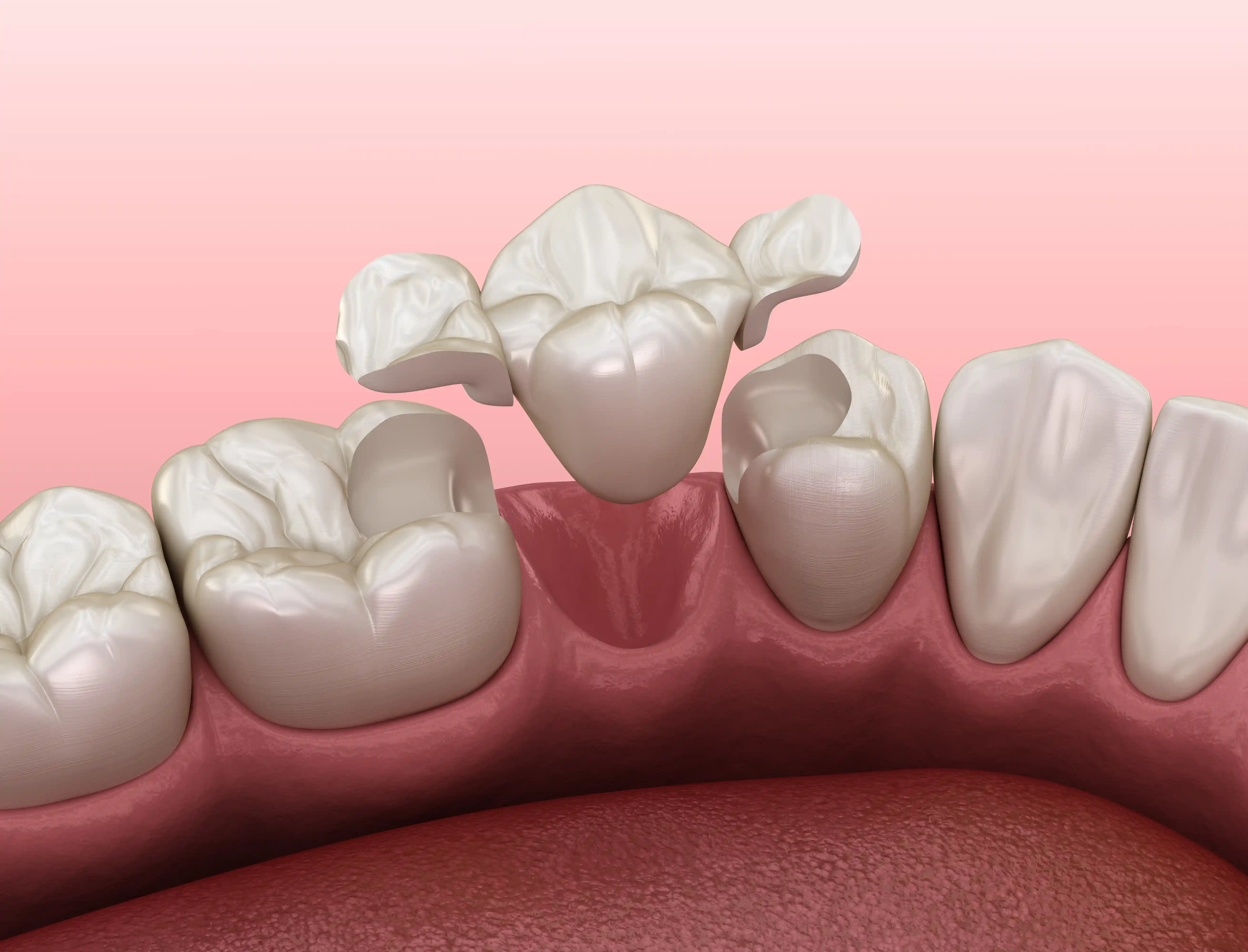 Maryland bridge dental restoration at Wimpole Street Medical and Dental