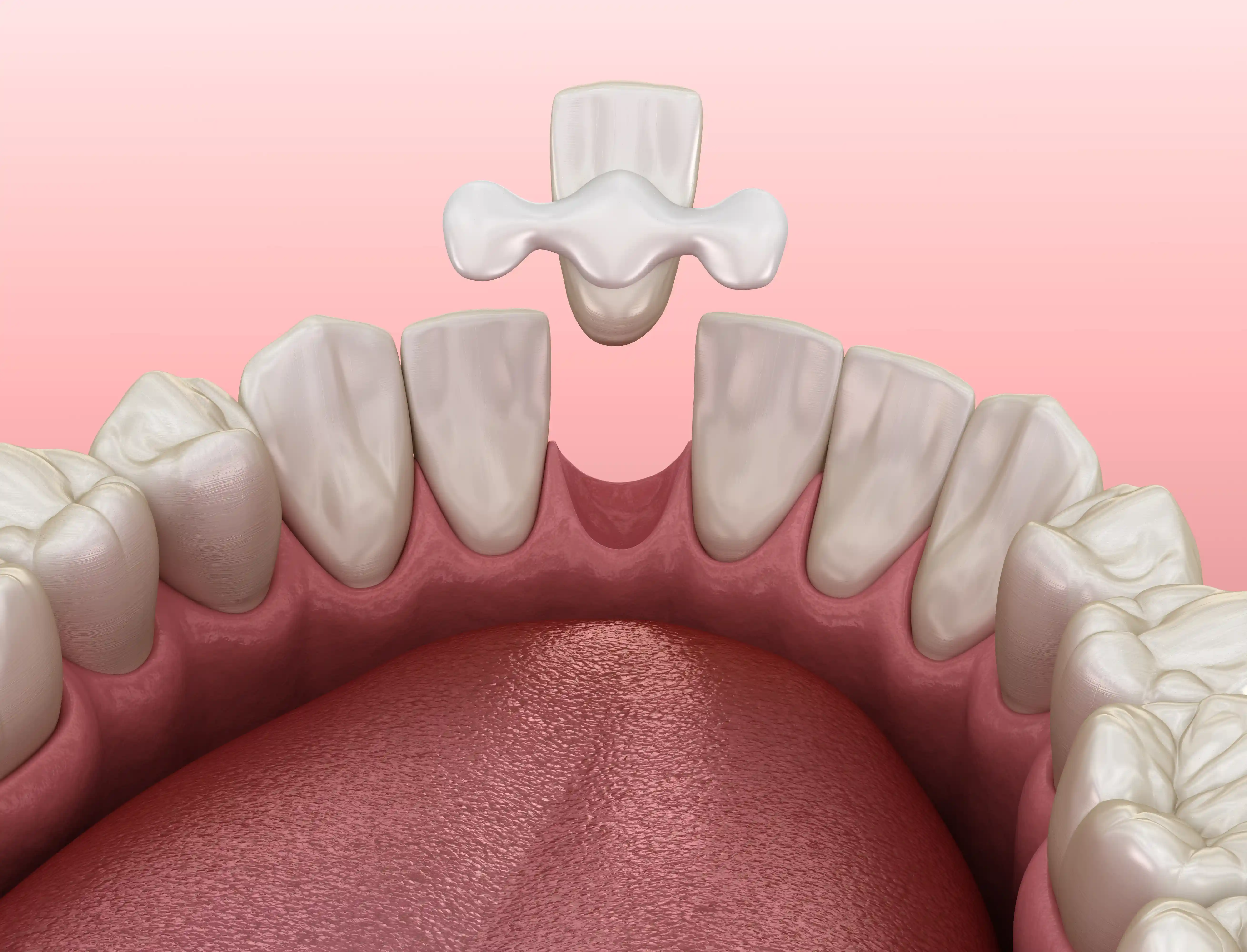 Resin bonded bridge example at Wimpole Street Medical and Dental