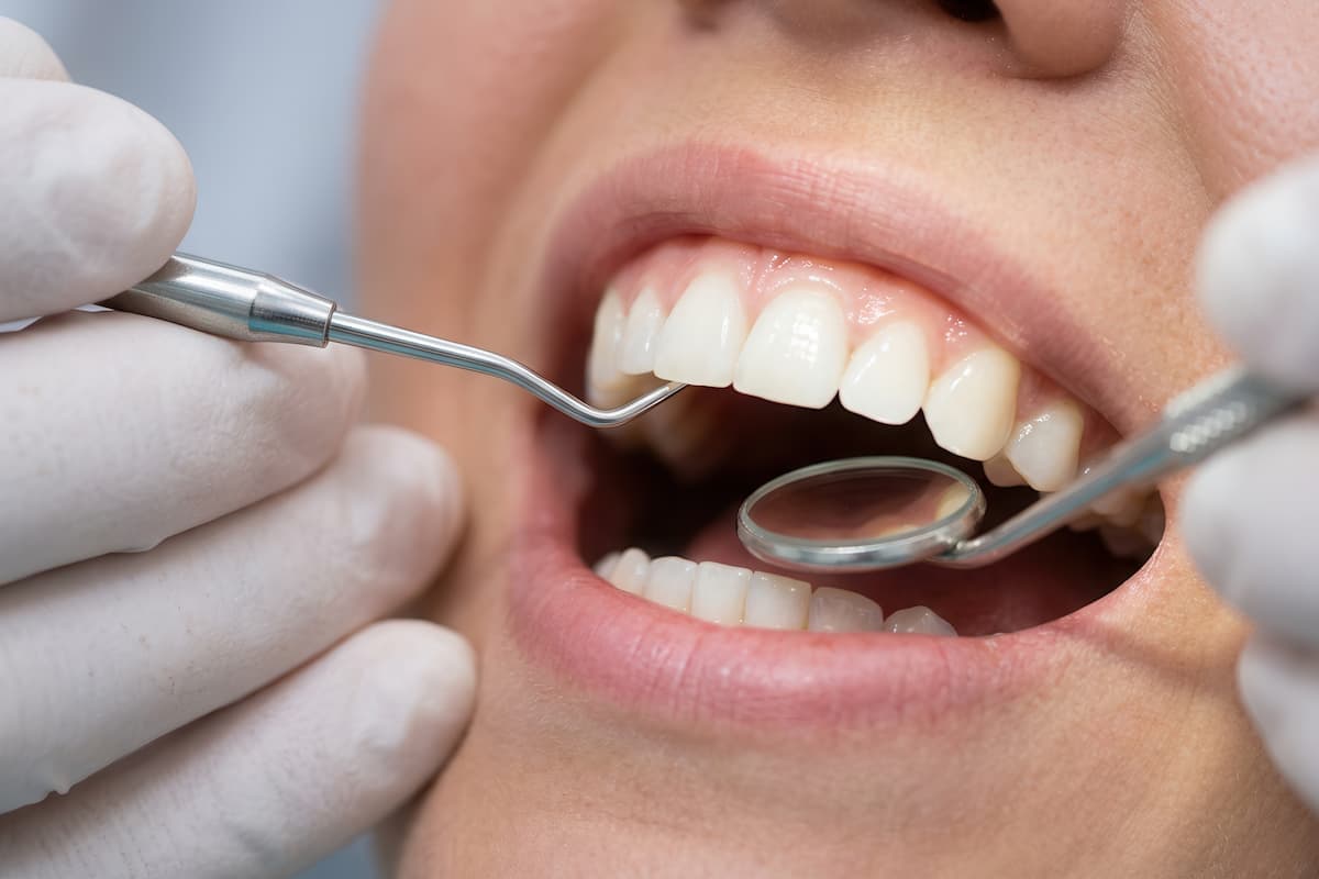 Food Trapped In Molar Grooves? How Dental Sealants Assist