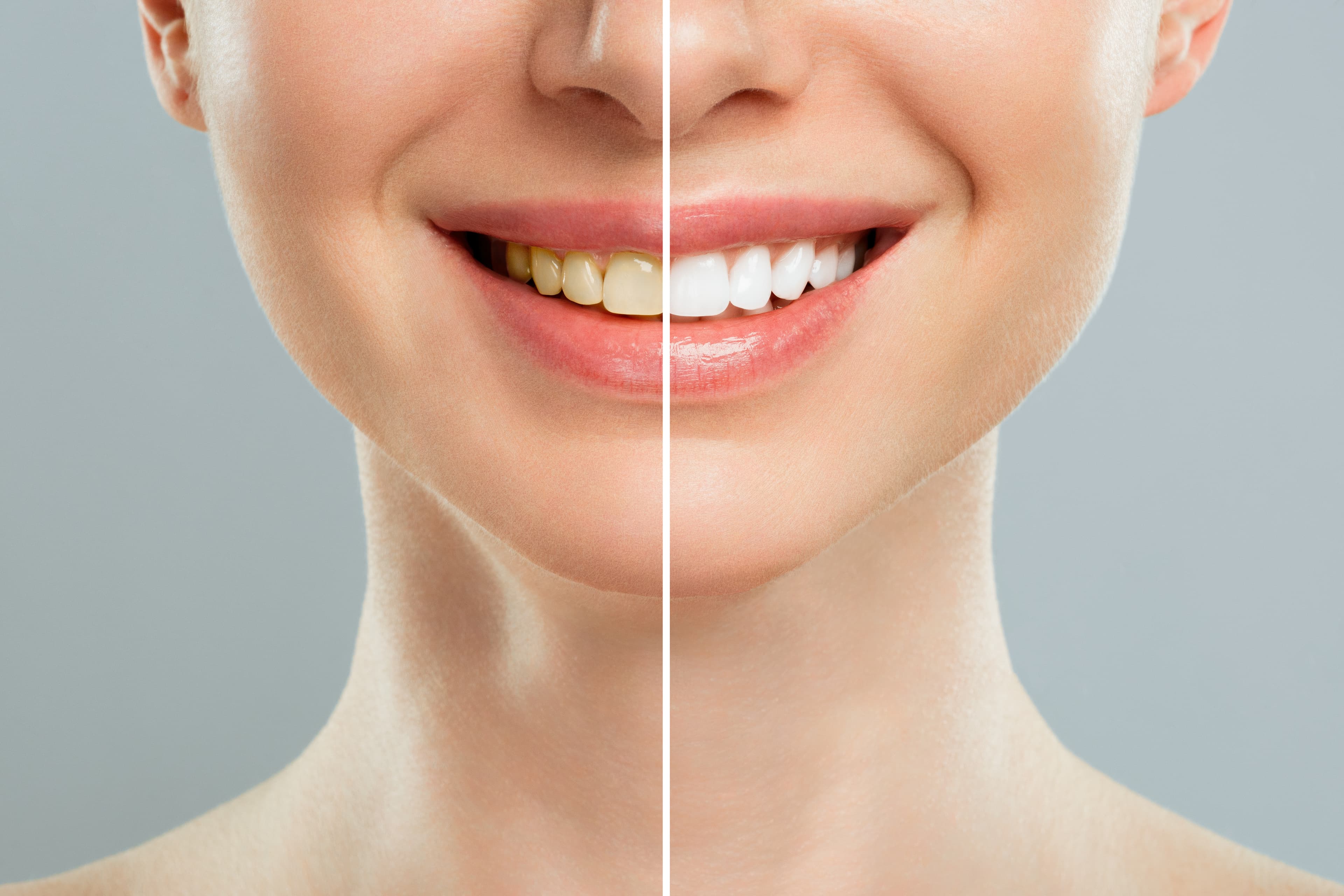 Why Do Teeth Become Yellow? Causes and Whitening Options