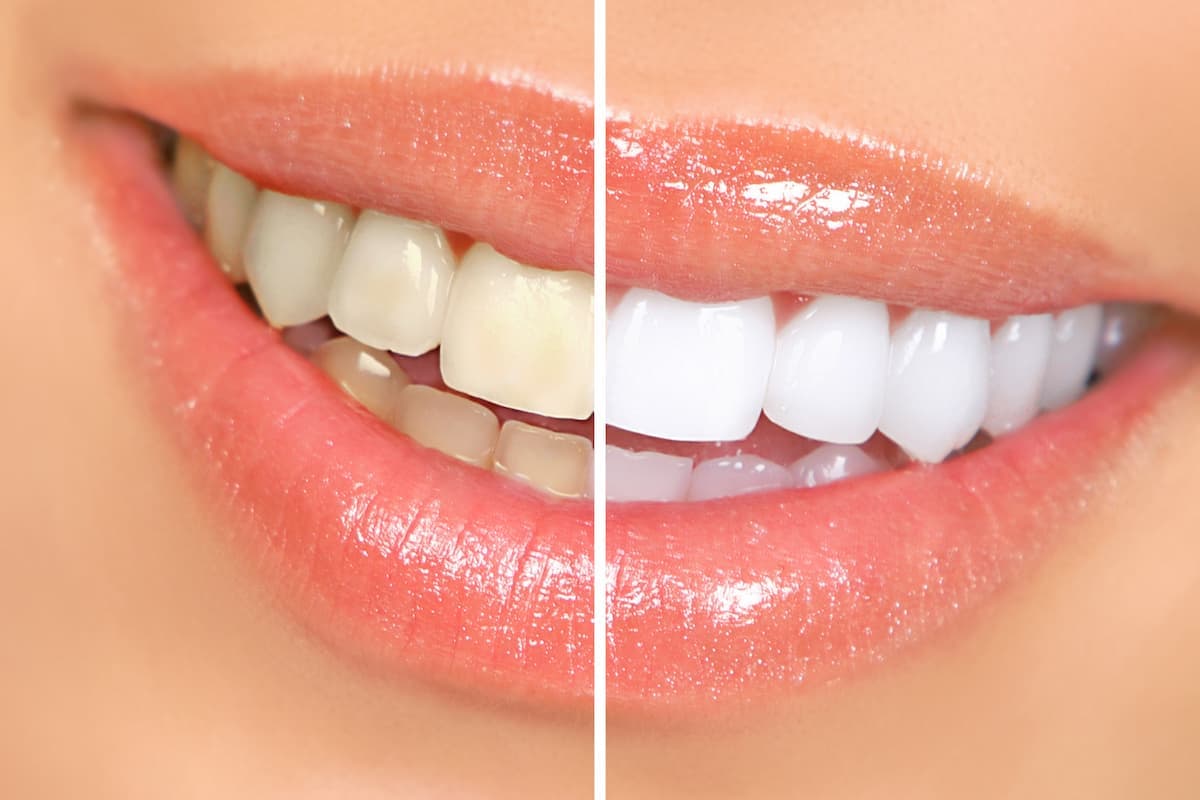 Why Cosmetic Dentistry Boosts Confidence and Self-Esteem