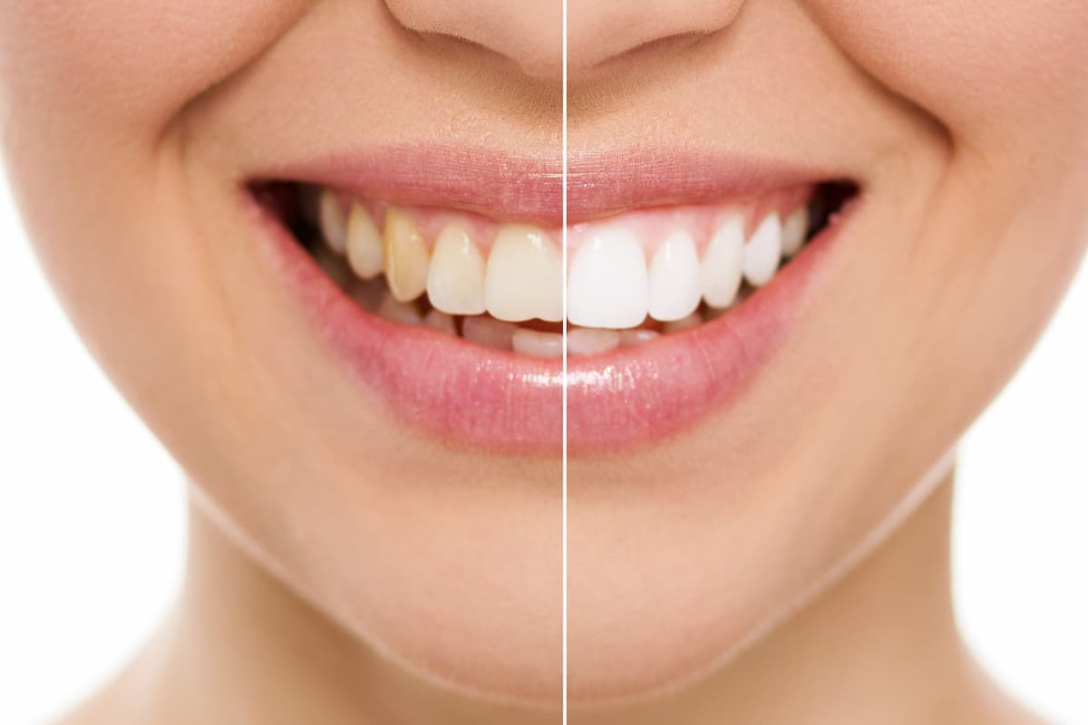 How Does Teeth Whitening Work For Stained Teeth At Home?
