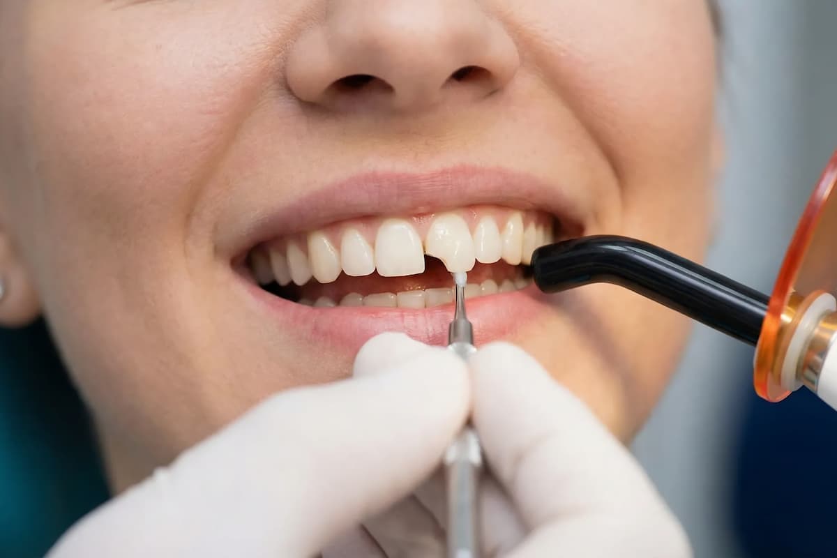 How Can Composite Bonding Help Restore Tooth Contours